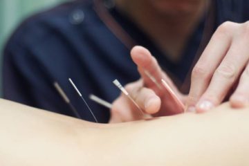 Acupuncture & Dry Needling